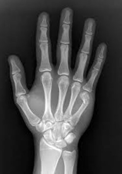 Metacarpal neck fracture.jpg