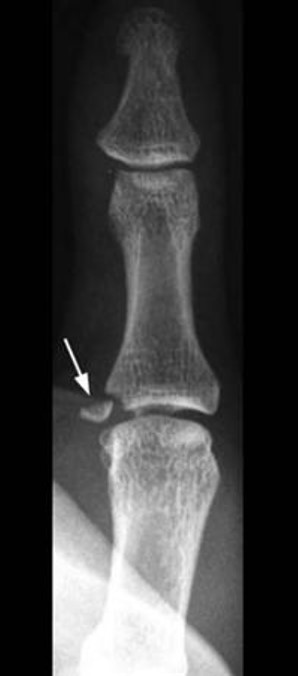 Ulnar collateral ligament avulsion fracture .jpg