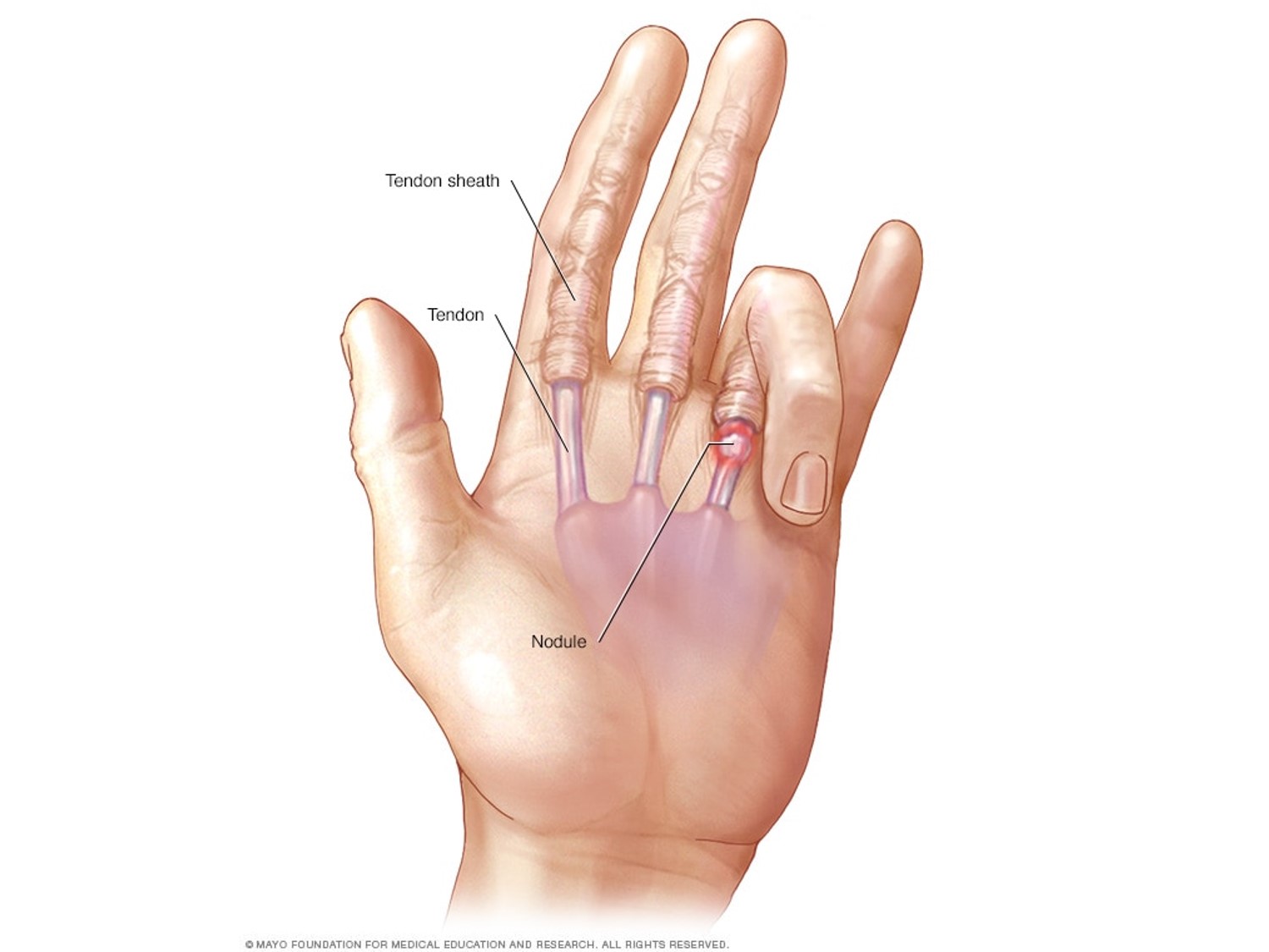 trigger finger 2.jpg