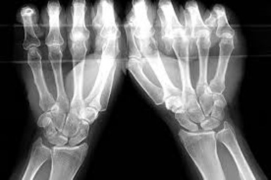 Bone xray.jpg