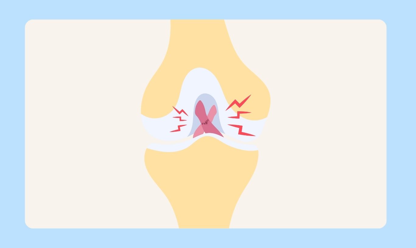 ACL and PCL Injuries.jpg