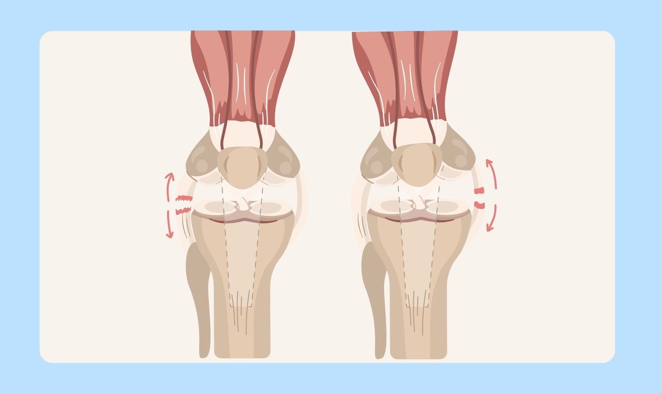 MCL and LCL Injuries.jpg